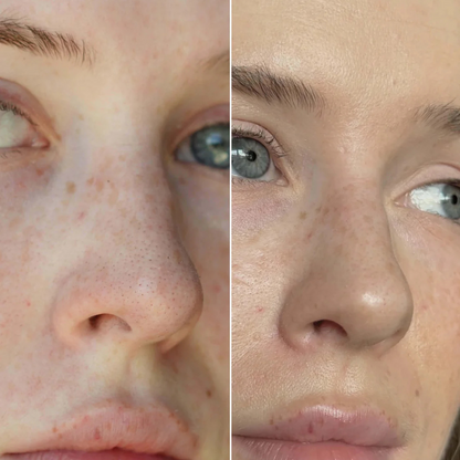 Pensos Nasais Purificantes para Eliminar os Pontos Negros e a Oleosidade (OFERTA 2X1)